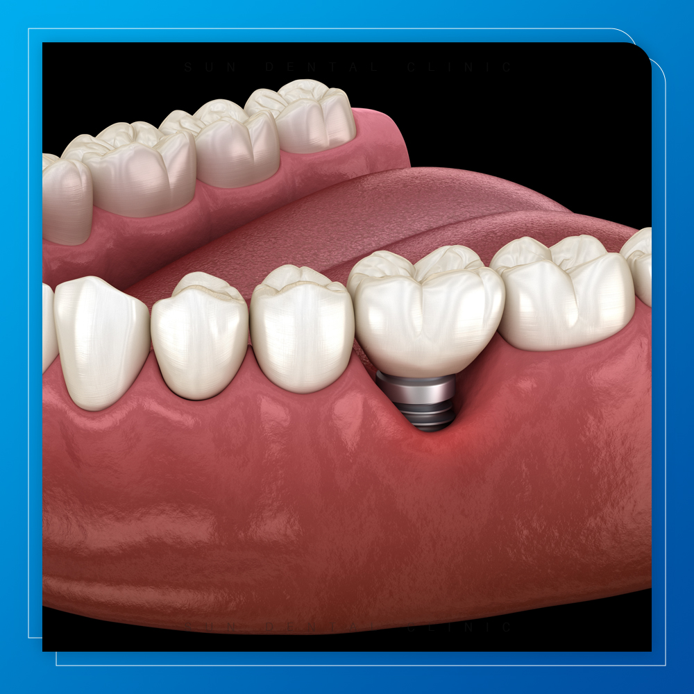 용인선플란트치과-처인구재수술임플란트-임플란트 주위염이 발생함을 보여주는 이미지