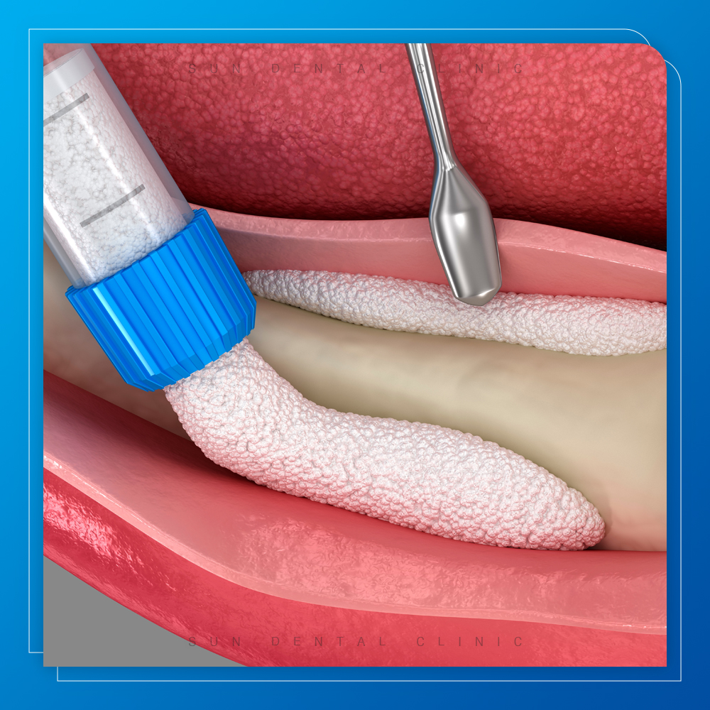 용인선플란트치과-처인구재수술임플란트- 뼈이식 임플란트