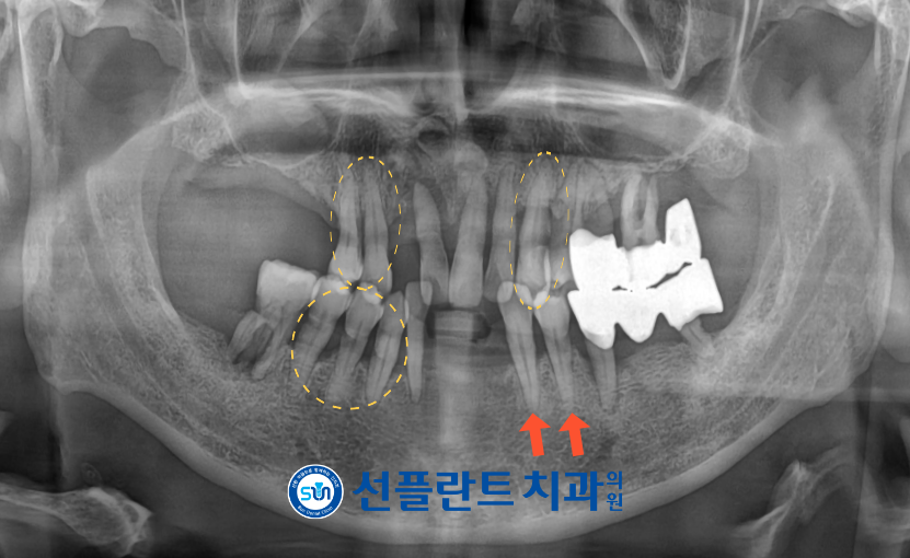 김량장동치과-용인선플란트치과-만성 치주염으로 인해 전반적인 치조골 소실이 확인되는 파노라마