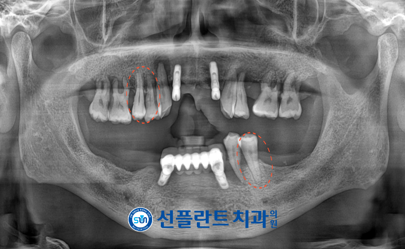 용인선플란트치과-임플란트-치료전