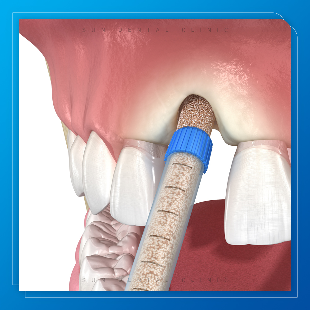 용인선플란트치과-처인구수면치과-뼈이식 이미지