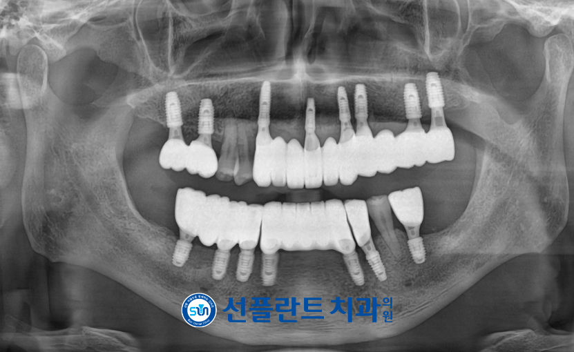 용인선플란트치과-임플란트-치료후