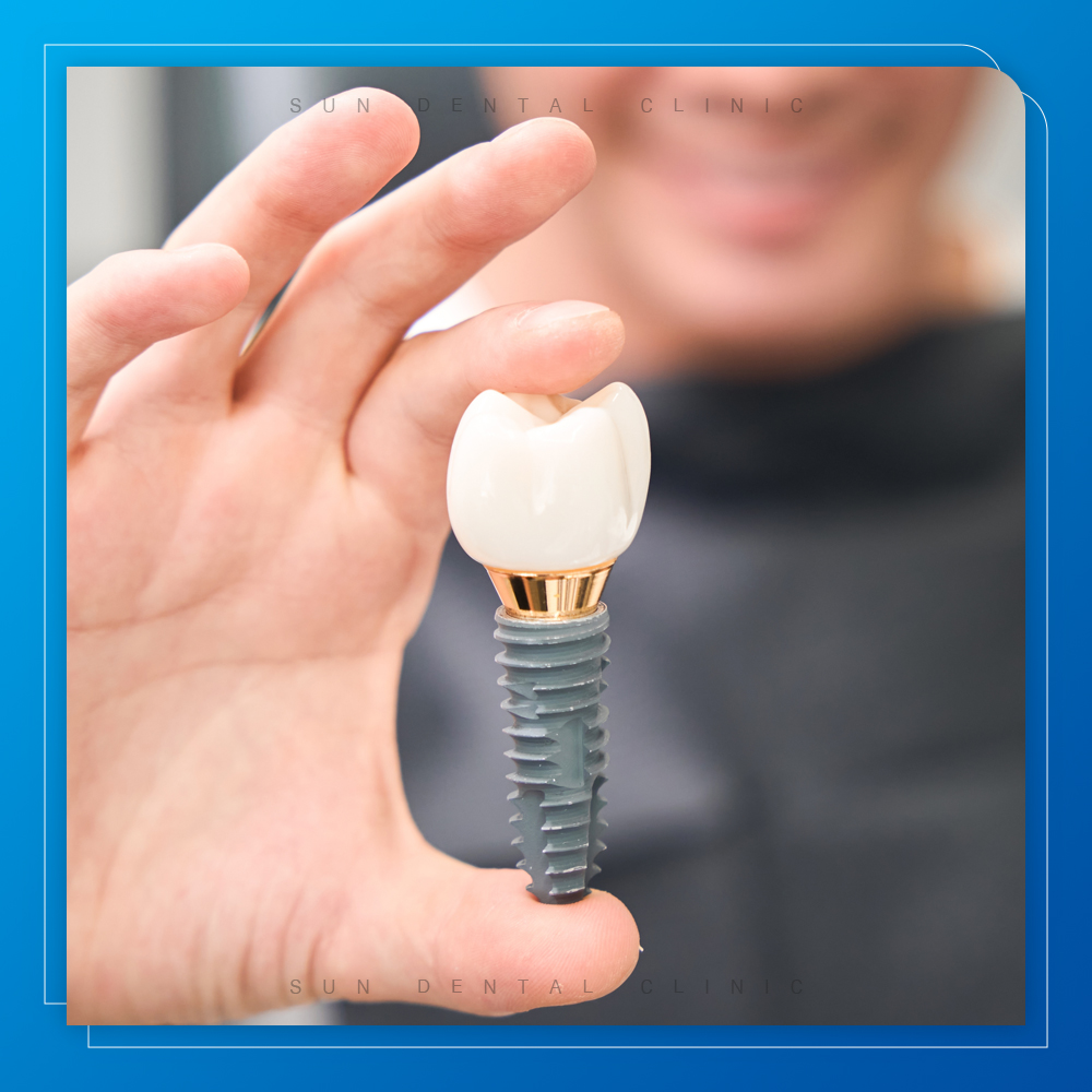 용인선플란트치과-처인구수면치과 -치과용 임플란트의 확대된 3차원 모델을 유지하는 심미적 치과의사 클라이언트