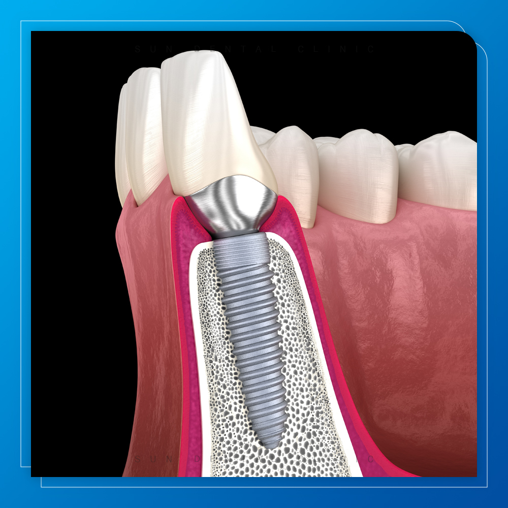 용인선플란트-처인구수면치과-임플란트 설명하기 위한 식립되어있는 이미지
