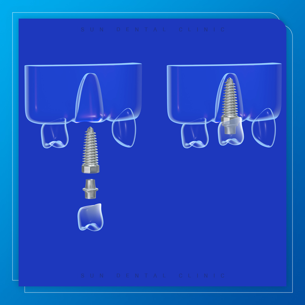 용인선플란트치과-처인구수면치과-디지털 임플란트 이미지
