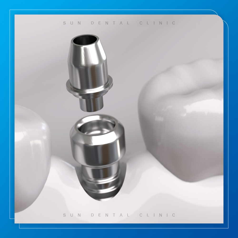 용인선플란트-처인구수면치과-임플란트 이미지