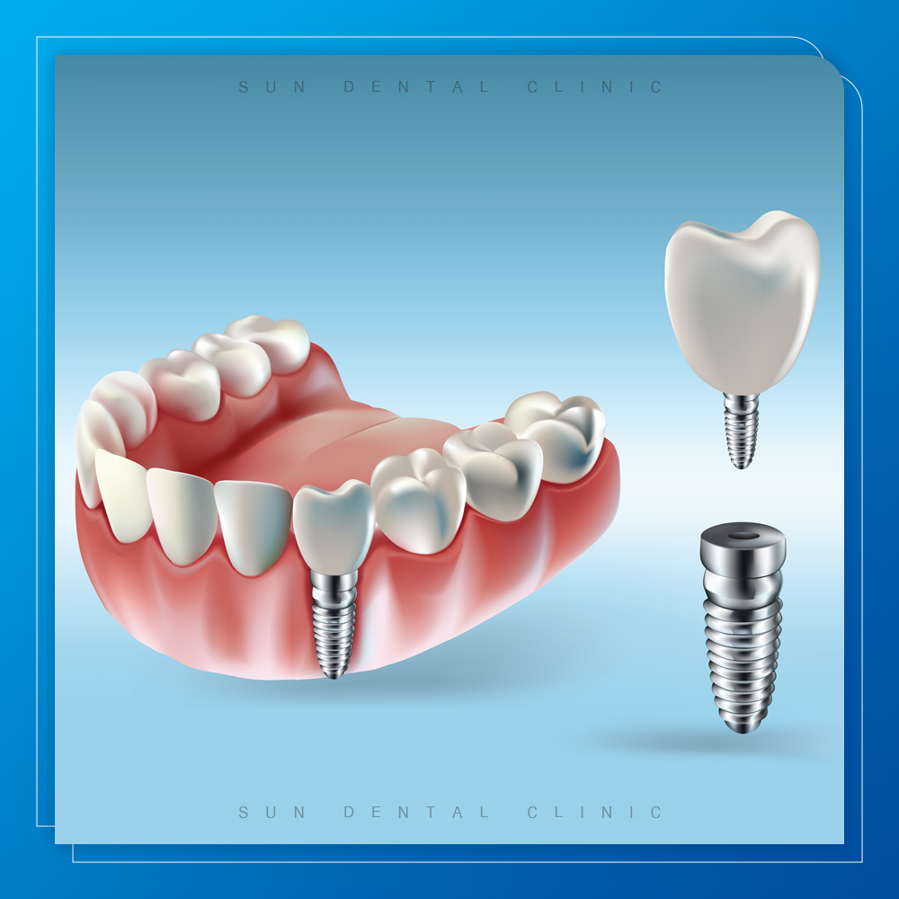 용인선플란트치과-처인구수면치과-임플란트 구조 이미지 및 식립된 모습