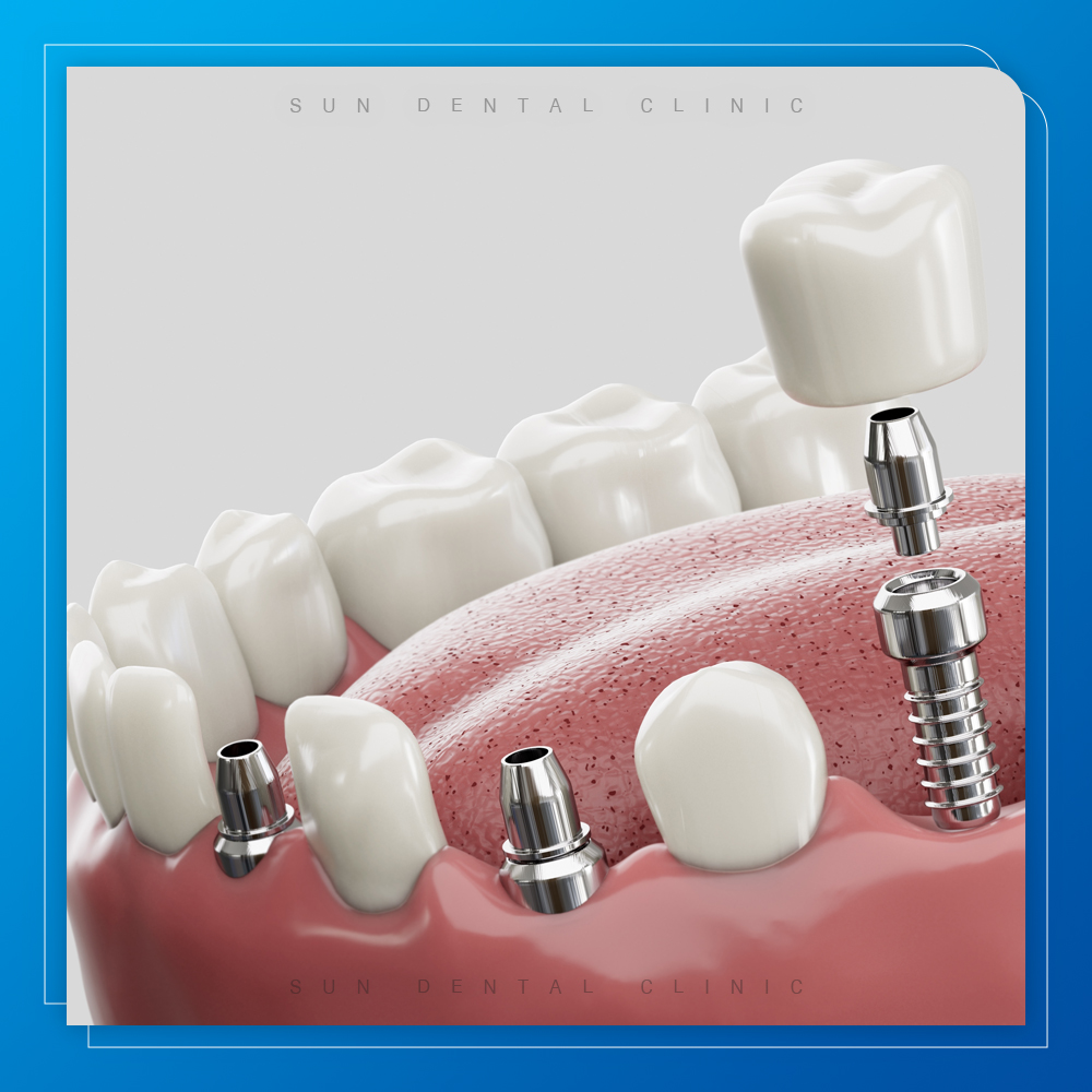 용인선플란트치과-처인구수면치과 -치아 임플란트 측면도 치과 임플란트 절차