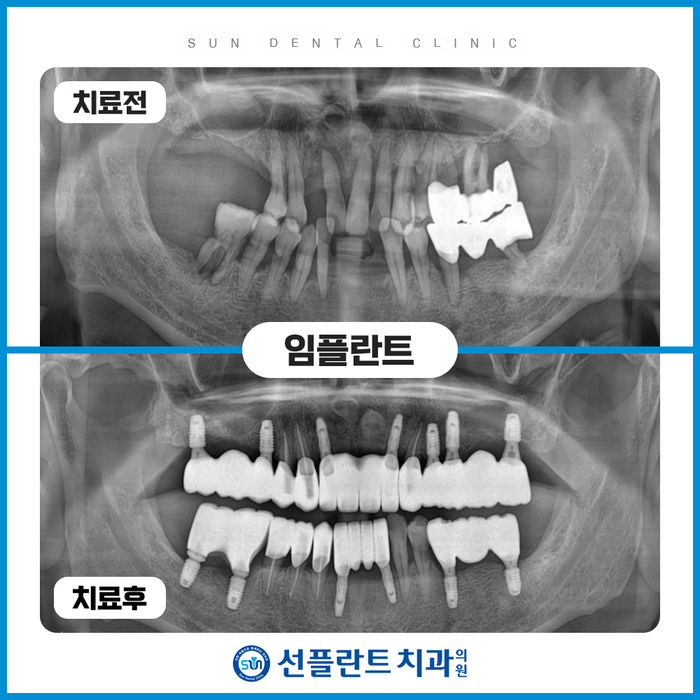 김량장동치과-용인선플란트치과-상악동 거상술을 동반한 임플란트 증례사진
