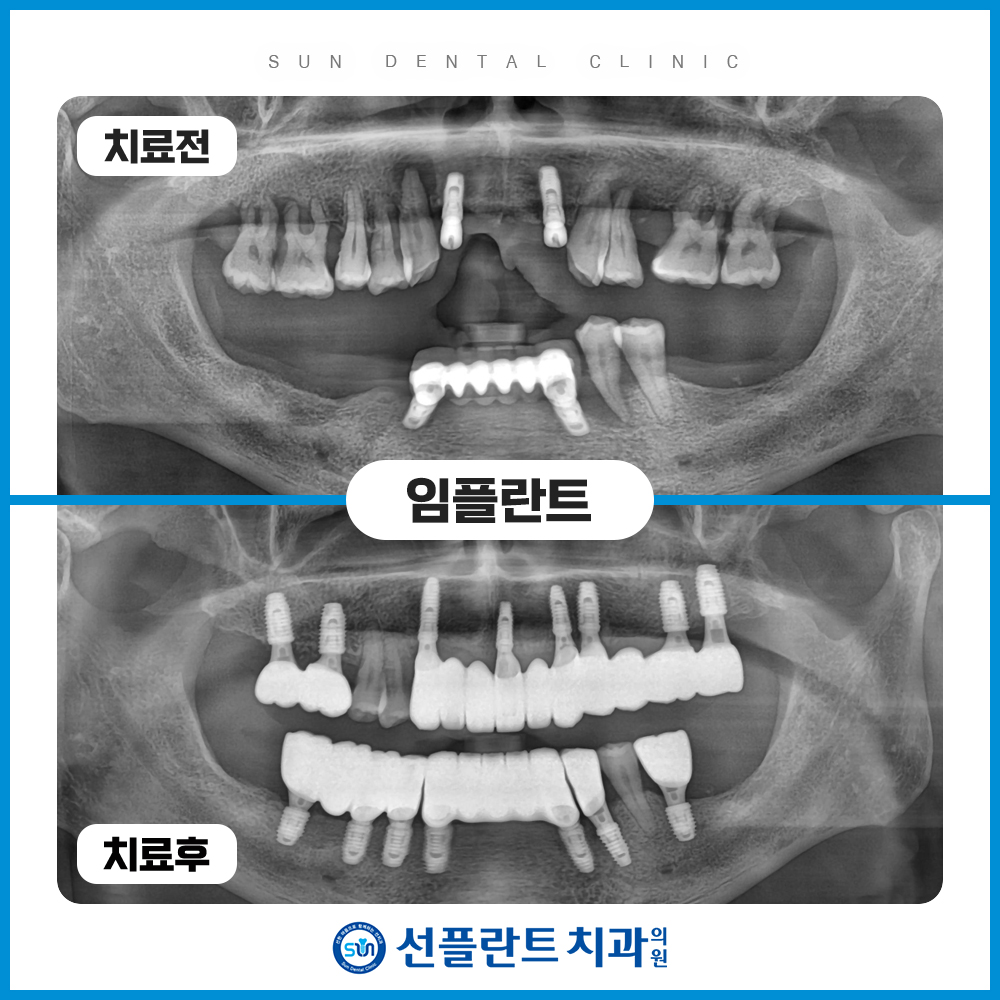 용인선플란트치과-임플란트-의식하진정법