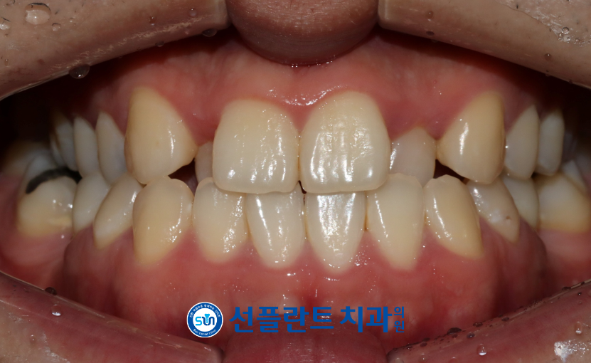 용인선플란트치과