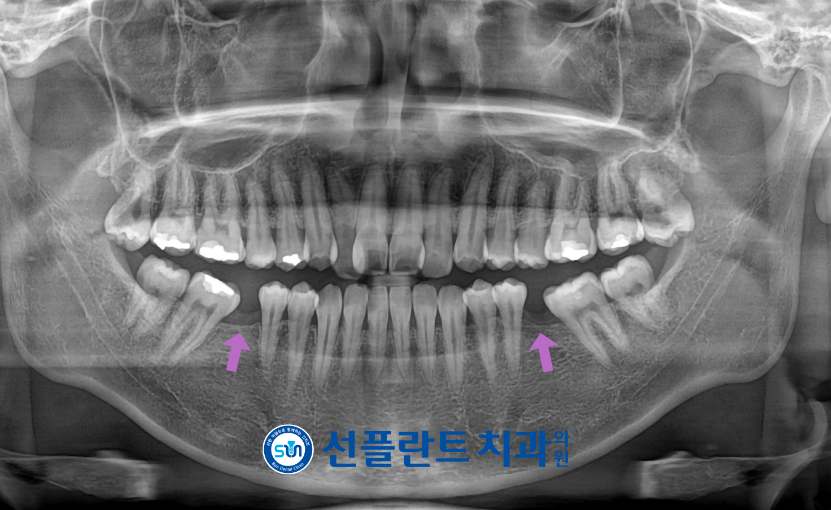 용인선플란트치과