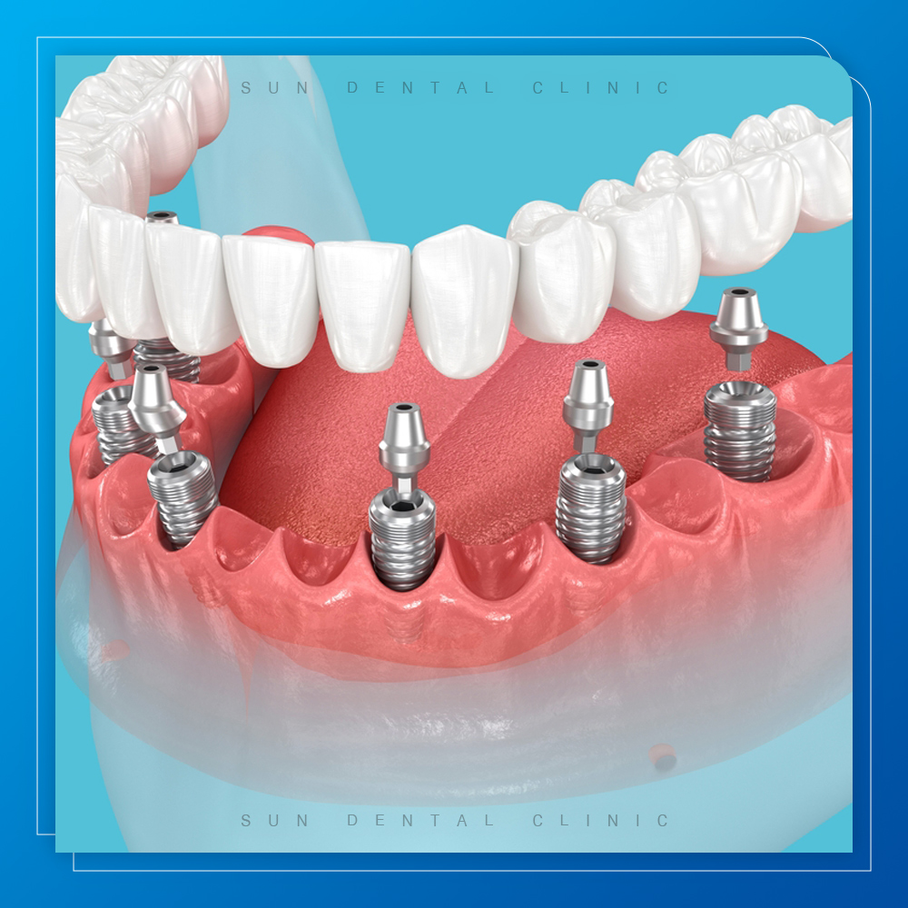 처인구수면치과