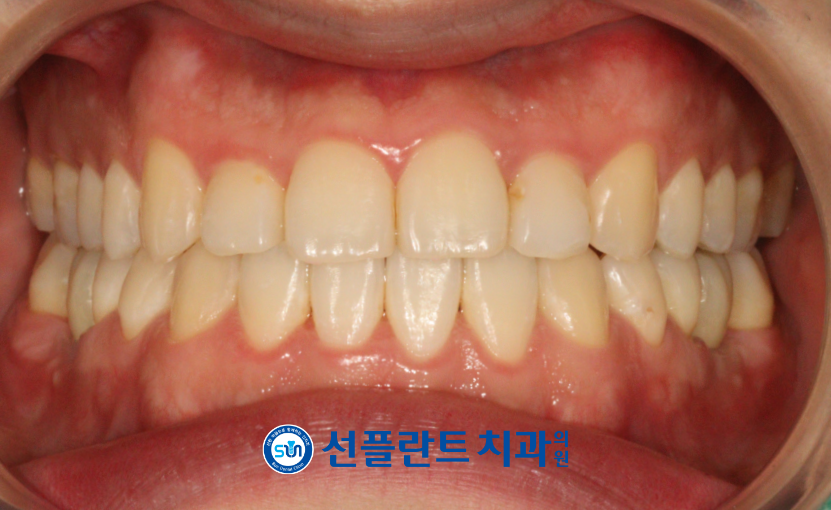 용인선플란트치과