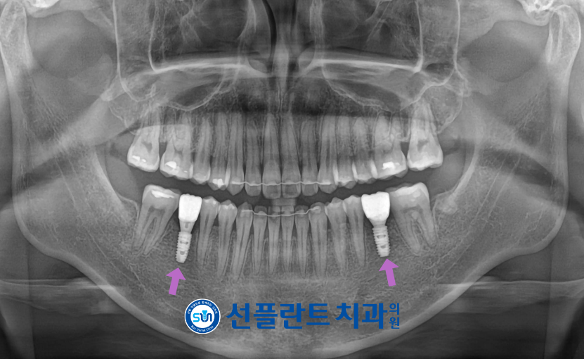 용인선플란트치과