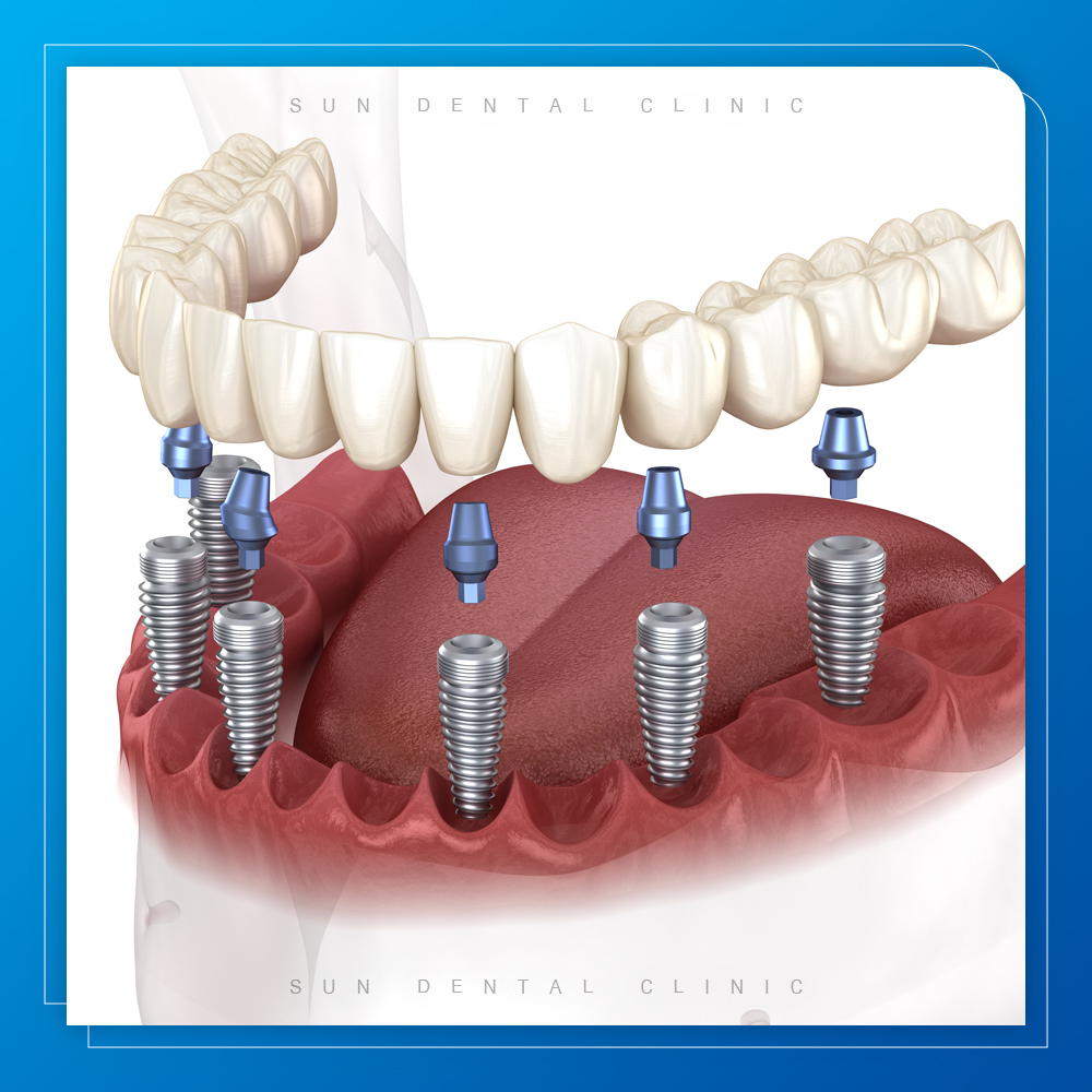 처인구수면치과
