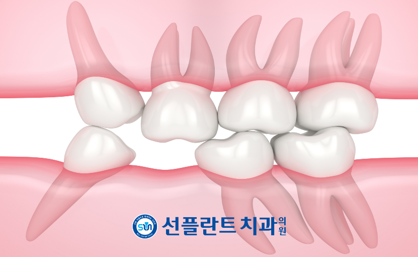 용인선플란트치과