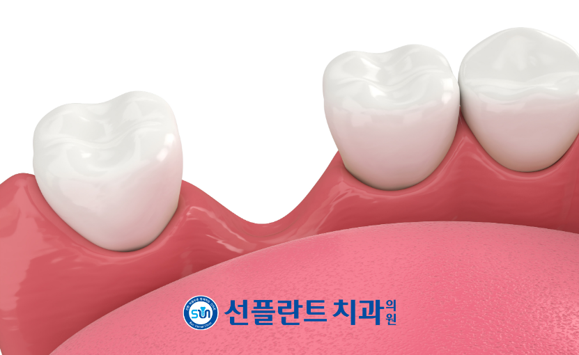 용인선플란트치과