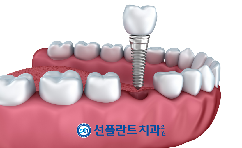 용인선플란트치과