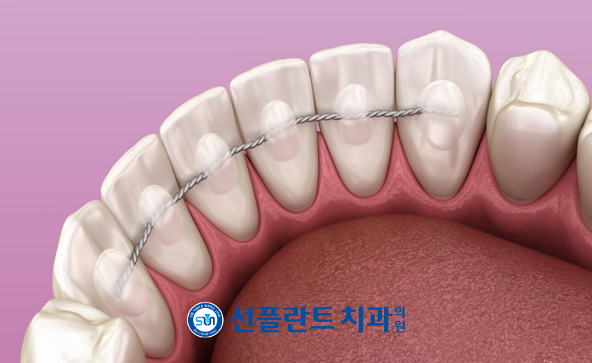 용인선플란트치과