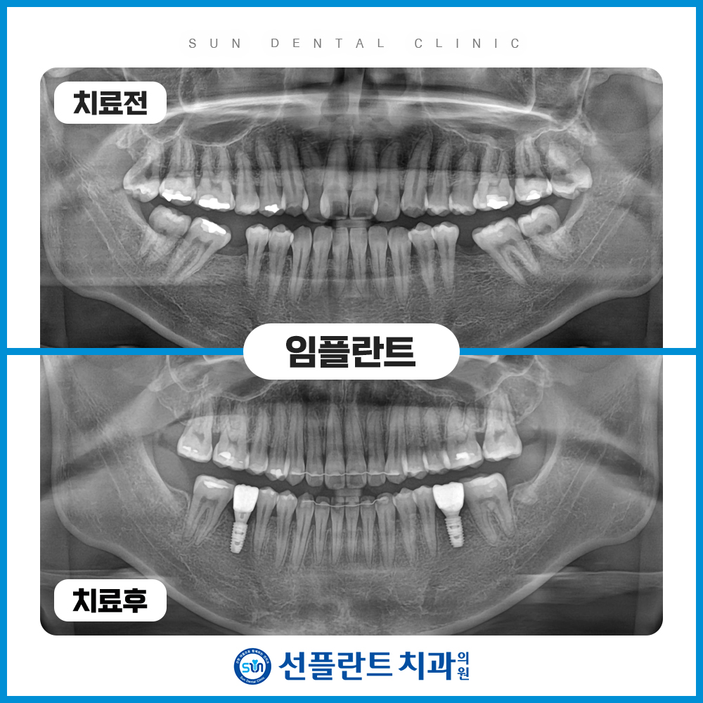 용인선플란트치과