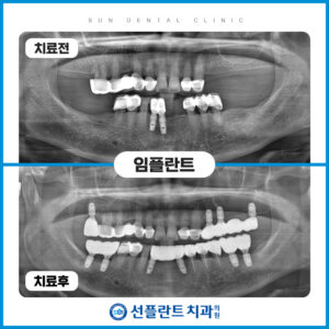 처인구임플란트