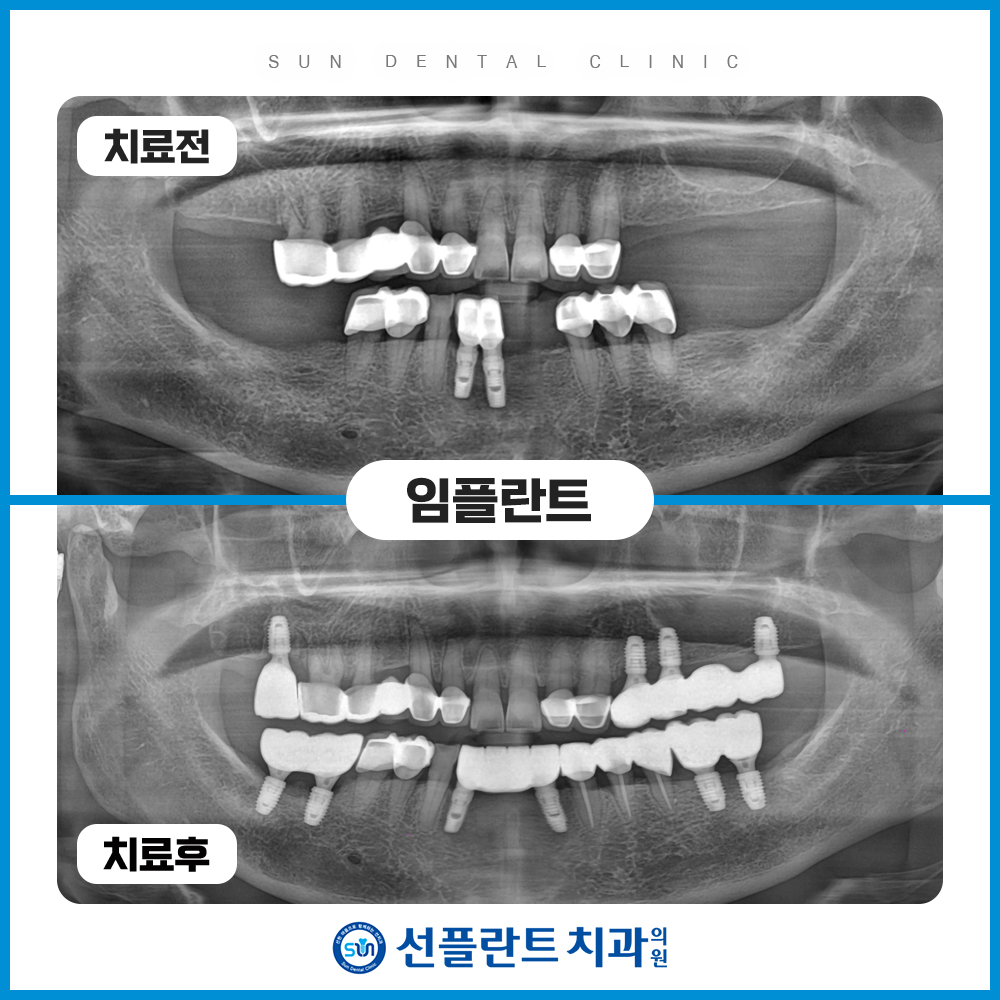 처인구임플란트