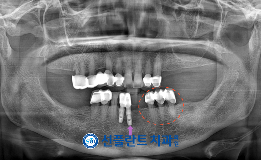 처인구임플란트