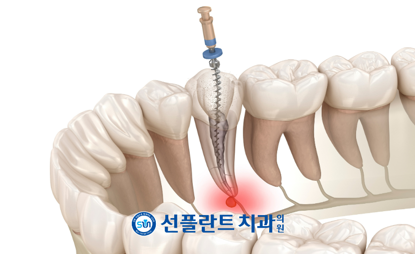 처인구임플란트