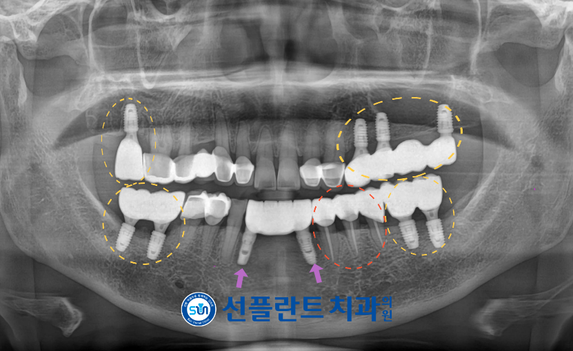 처인구임플란트