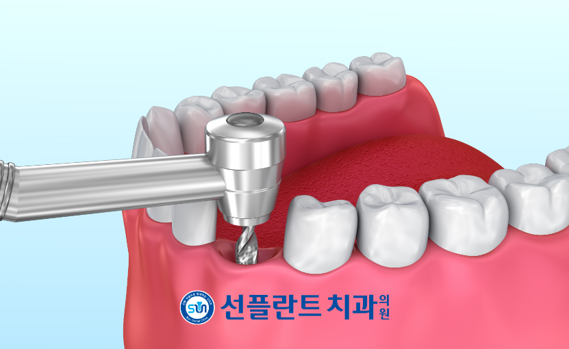처인구임플란트