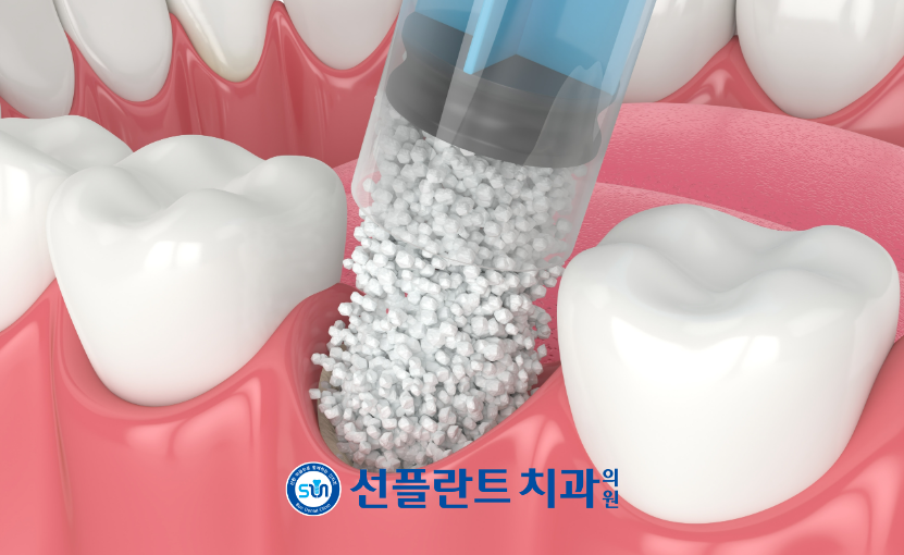 처인구임플란트
