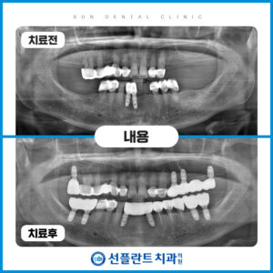 처인구임플란트
