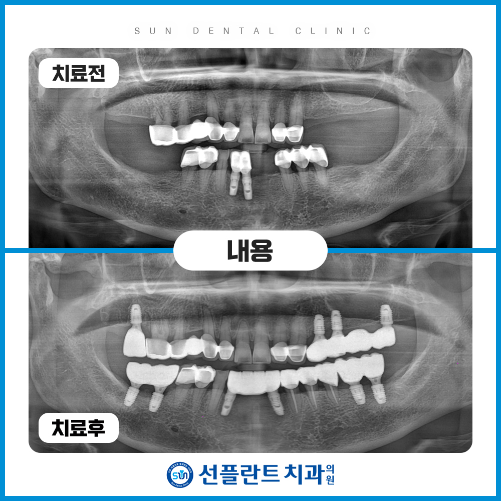 처인구임플란트